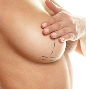 implant-mammaire-gautier-michel